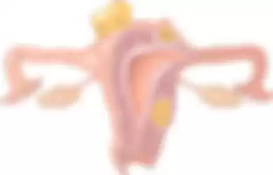 Ilustrasi endometriosis. Peradangan yang terjadi akibat endometriosis dapat merusak sel telur dan sperma. Kondisi ini tentunya mengganggu kesuburan dan dapat menghalangi terjadinya pembuahan.