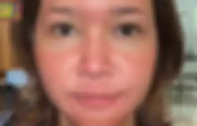 Foto Maia Estianty mengidap rosacea.