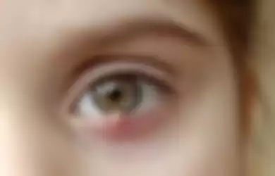 Tanda pada kelopak mata yang bisa jadi pertanda radang kelopak mata