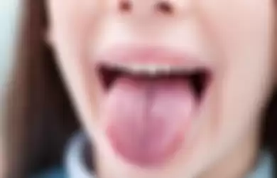 Kanker lidah yang ternyata bisa terjadi karena sering makan makanan panas