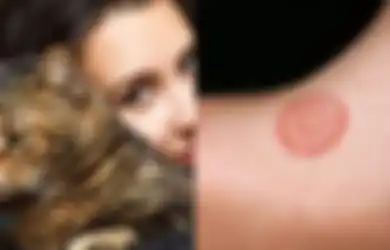 Pecinta Kucing dan Anjing Wajib Tahu, Ringworm Luka Melingkar di Tubuh Anda Bisa Jadi Ketularan dari Binatang Peliharaan Anda, Apa itu Ringworm?