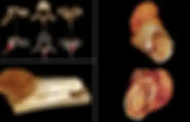 Berusia 1,7 Juta Tahun, Tulang Kaki yang Ditemukan Peneliti Ini Terbukti Adanya Kanker, Jadi Apakah Diet Paleo yang Dilakukan Manusia Purba Bisa Hilangkan Penyakit Mematikan Itu?
