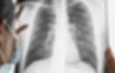 Tahap stadium kanker paru membantu mengetahui penyebaran sel kanker di tubuh.
