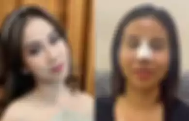 Mayang adik Vanessa Angel operasi hidung