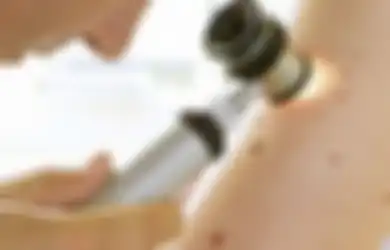 Coba Hitung Tahi Lalat di Lengan Kananmu, Ini Bisa Mendeteksi Kanker Kulit