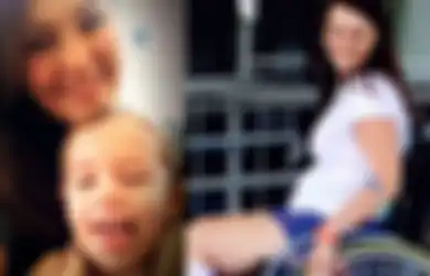Jo Gilchrist, Wanita Australia yang Lumpuh Seumur Hidup Setelah Meminjam Make-Up Teman