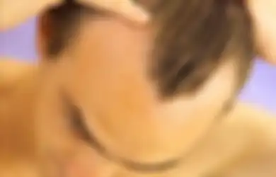 Ketika Rambut Pria Menipis Gara-gara Kebotakan (2)