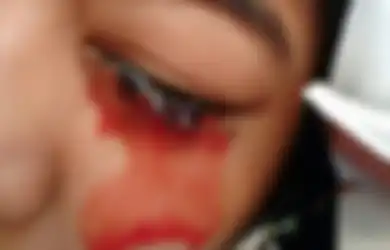 Gadis Ini Menderita Penyakit Langka yang Membuatnya Berkeringat Darah