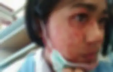 Sedih! Karena Kondisi Langka, Gadis 14 Tahun Ini Keluarkan Darah dari Mata, Hidung, dan Telinganya