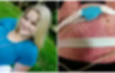 Duh! Gara-gara Terkena Penyakit Langka, Ibu Ini Alergi pada Bayi yang Dikandungnya Sendiri