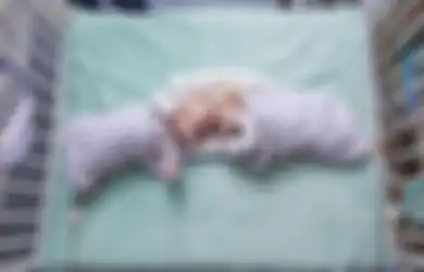 Luar Biasa! Akhirnya Bayi Kembar Siam di Kepala Ini Bisa Dipisahkan dan Hidup Normal