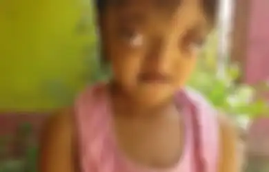 Gadis 8 Tahun yang Terus Menerus Diejek karena Matanya Menonjol ke Depan Ini Akhirnya Sukses Menjalani Operasi
