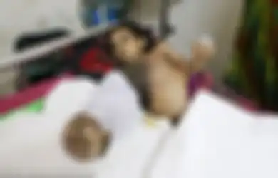 Tangan dan Dadanya Menyerupai Kulit Kayu, Gadis 12 Tahun Ini Dijuluki Manusia Pohon