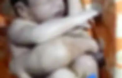 Bayi Kembar Parasit dengan Kaki dan Kelamin Ganda Ini Nyaris Dibuang ke Sungai, Kini Ia Sukses Menjalani Operasi