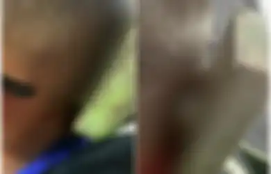 Sedih, Anak dengan Autisme Ini Tidak Hanya Di-bully Tapi juga Dilempari Papan Berpaku Hingga Menancap di Kepalanya