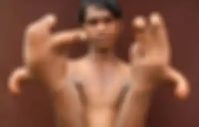 Kasihan! Gara-gara Punya Jari-jari yang Besar dan Panjang, Bocah Ini Dijuluki ‘Iblis’