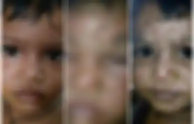 Wajahnya Terkena Infeksi, Bocah Ini Justru Dibawa ke Dukun Ilmu Hitam. Hasilnya Mengerikan
