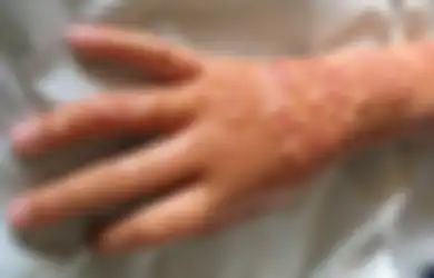 Jangan Sampai Anak Gadis Anda Menderita Seperti Ini Gara-gara Henna