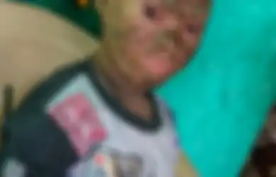 Gadis India dengan Kulit Bersisik Ini Mengingatkan Kita pada Sosok Jambunada di Serial Mahkota Mayangkara