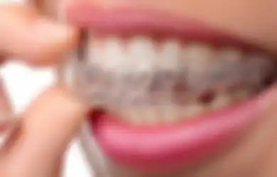 Anda Menderita Bruksisme? Segera ke Dokter Gigi Sebelum Terlambat!
