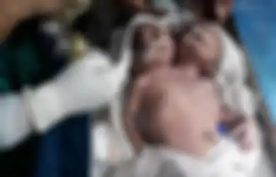 Sedih, Bayi Kembar Siam Dengan Dua Kepala dan Satu Tubuh Ini Hanya Bisa Bertahan Hidup Selama 24 Jam Saja