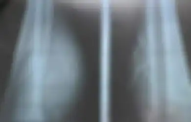 Ngeri! Selama 5 Tahun, Kaki Wanita Ini Dipenuhi 70 Jarum dan Paku. Dokter pun Tercengang