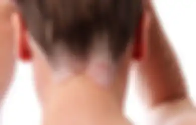 Hati-hati! Ketombe yang Sulit Hilang dan Kulit Kepala Bersisik Bisa Jadi Tanda Psoriasis