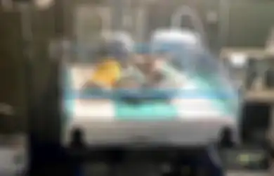 Tidak Pernah Cek Kehamilannya, Wanita India Ini Melahirkan Bayi Kembar Siam yang Jantung dan Hatinya Menyatu