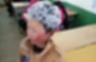 (Foto) Suhu Anjlok Drastis, Rambut Bocah Ini Membeku, Bahkan Tangannya 'Retak'