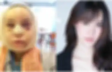 (Foto) Operasi Plastik Tidak Seinstan yang Dibayangkan, Wanita Ini Menderita 3 Bulan Setelah Jalani Operasi