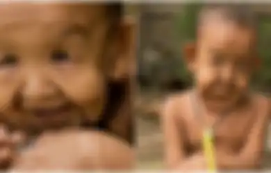 Terkena Sindrom Langka, Anak 6 Tahun Ini Terlihat Seperti Kakek Berusia 80 Tahun