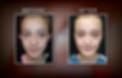 Bullying Menyebabkan Gadis Berusia 11 Tahun Ini Menjalani Operasi Plastik, Lihat Perbedaannya