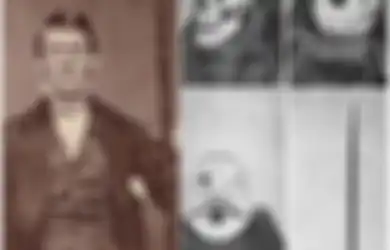 Kasus Medis Paling Mengejutkan Dalam Sejarah: Pria Ini Selamat Meski Tengkorak Kepalanya Tertembus Batang Besi