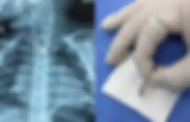 Peringatan untuk Para Orang Tua, Balita Ini Menelan Cincin Berlian Saat Ibunya Sedang Tidur