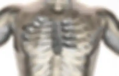 Penderita Kanker ini Mendapat Tulang Rusuk Pertama yang Dibuat dengan Teknologi Percetakan 3D
