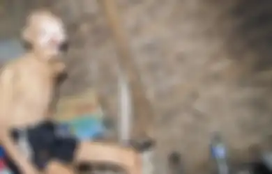 Tragisnya Nasib Kakek Karep, Diusir Keluarga karena Mengidap Kanker Kulit