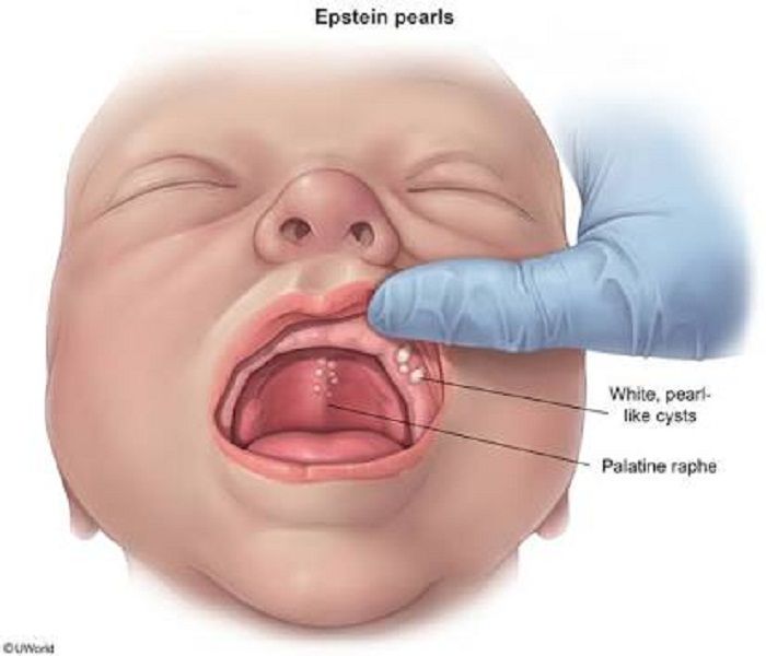 Epstain Pearls yang terdapat pada mulut bayi.
