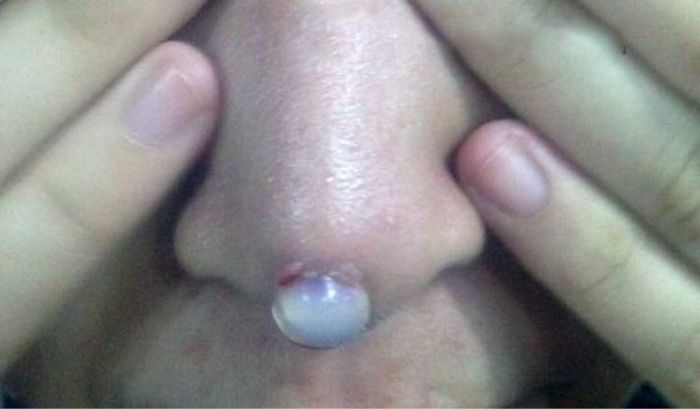 Implan Silikon Hidung yang Gagal