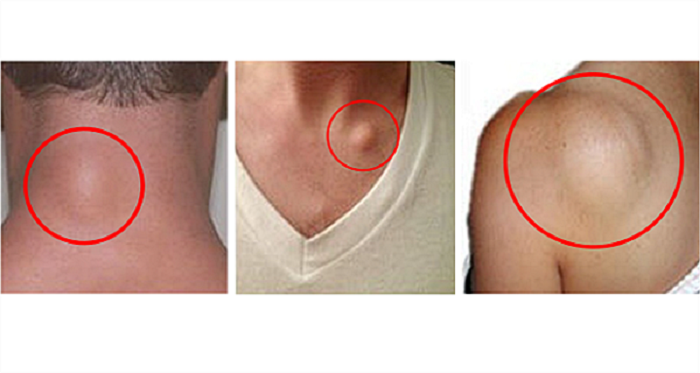 Benjolan lemak alias lipoma, ada yang berbahaya, tapi umumnya tidak berbahaya.