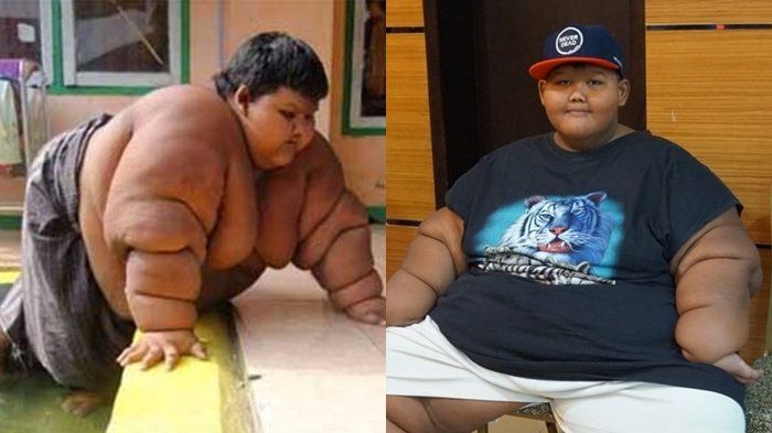 Arya Permana, bocah obesitas