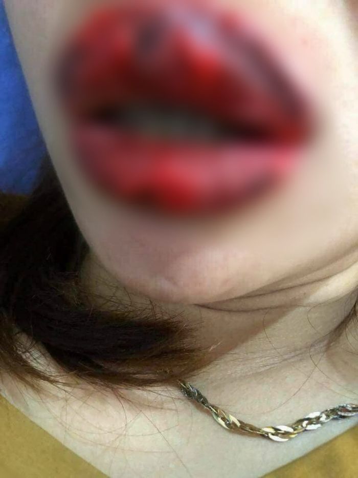 Bibir wanita ini terinfeksi dan bengkak.