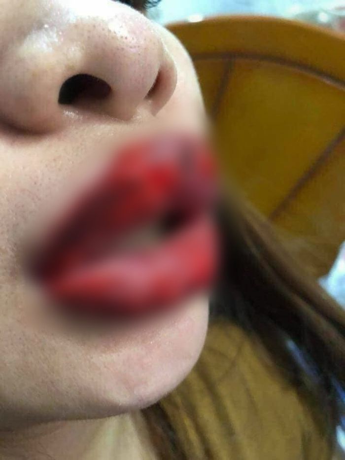 Bibir wanita ini terinfeksi dan bengkak.