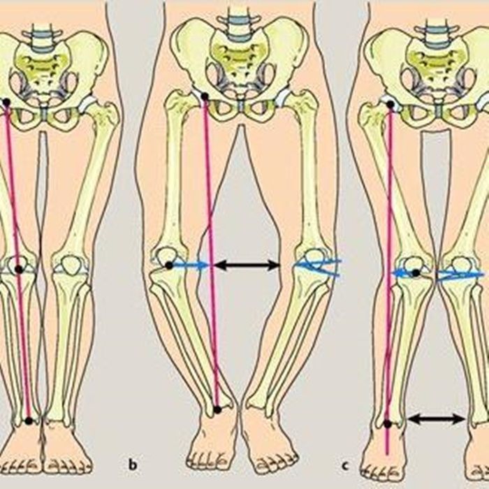 Netizen Khawatirkan Kaki Rafathar, Apa Penyebab Bentuk Kaki O dan X