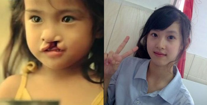 Li Lan anak bibir sumbing yang menginspirasi