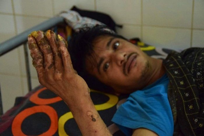 Abul Bajandar yang mengidap penyakit langka.