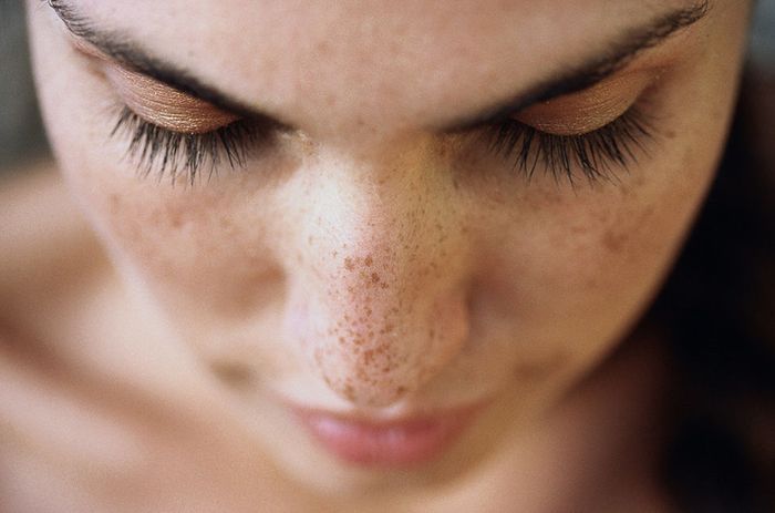 Tanda bahwa skincare tidak cocok: bintik hitam