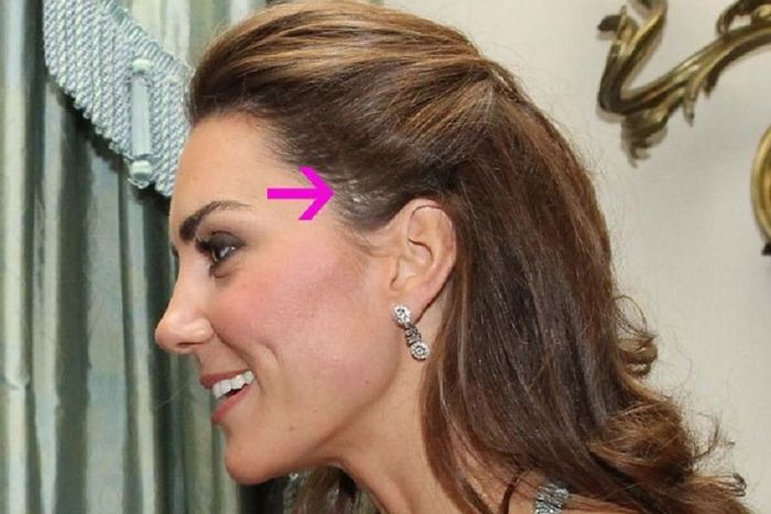 Ternyata Kate Middleton Punya Bekas Luka Di Kepala Kenapa Ya Semua Halaman Nova