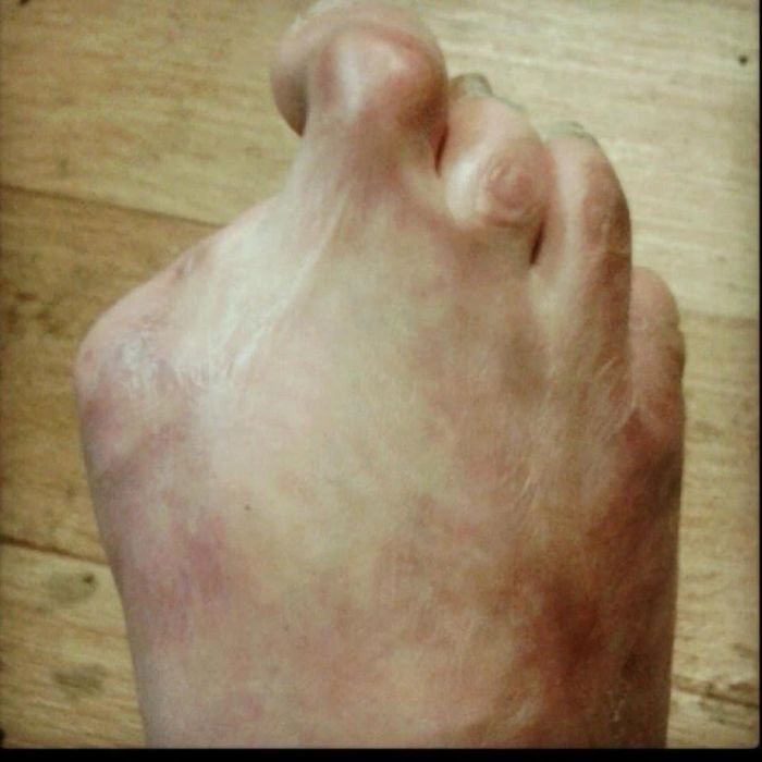 Ngeri Setelah Spa Ikan Jari Kaki Kanan Wanita Ini Terinfeksi Hingga Harus Diamputasi Semua Halaman Intisari