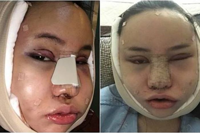 Operasi plastik Piya