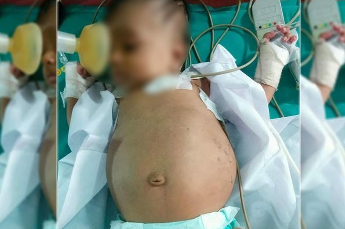 Bayi asal india mengalami kondisi langka dimana perutnya membuncit karena berisi janin